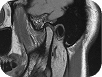 TMJ (MRI)