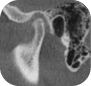 TMJ (CBCT)